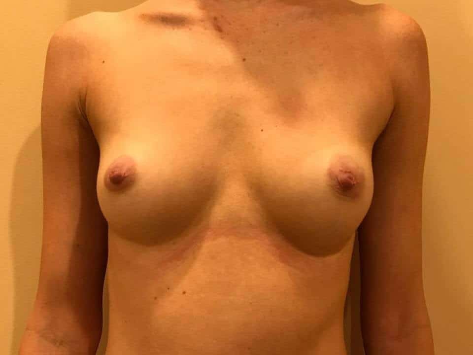 Before & After Patient