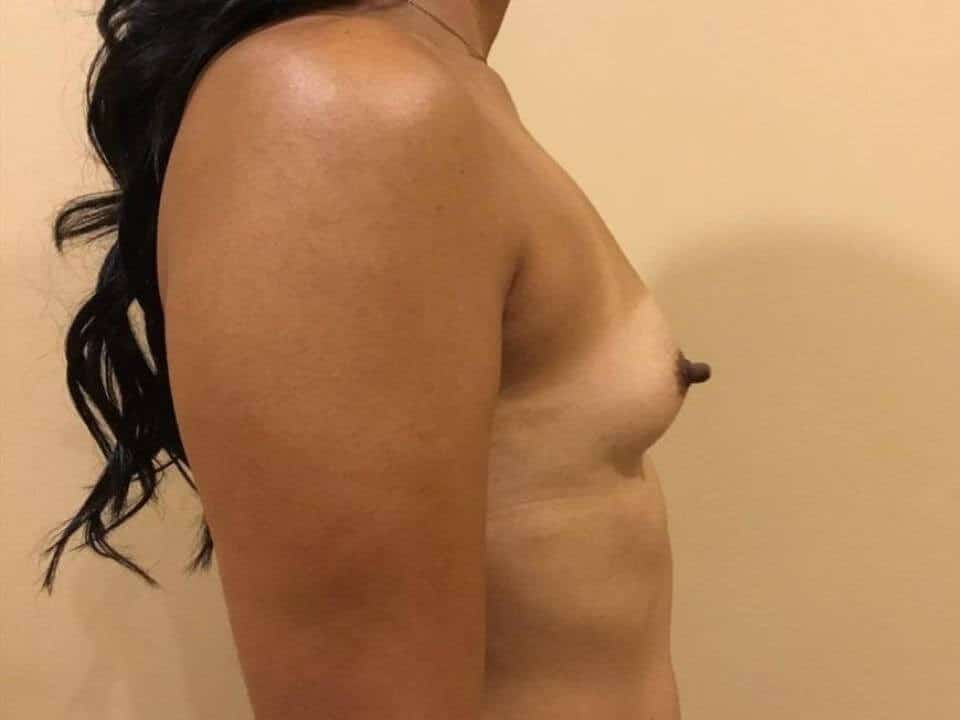 Before & After Patient