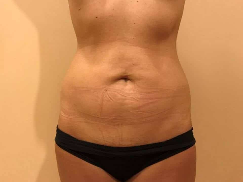 Before & After Patient