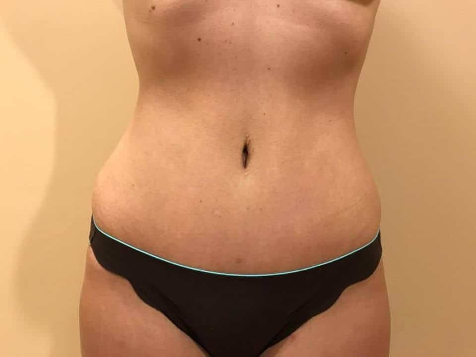 Before & After Patient