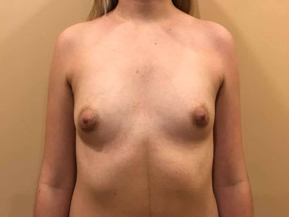 Before & After Patient