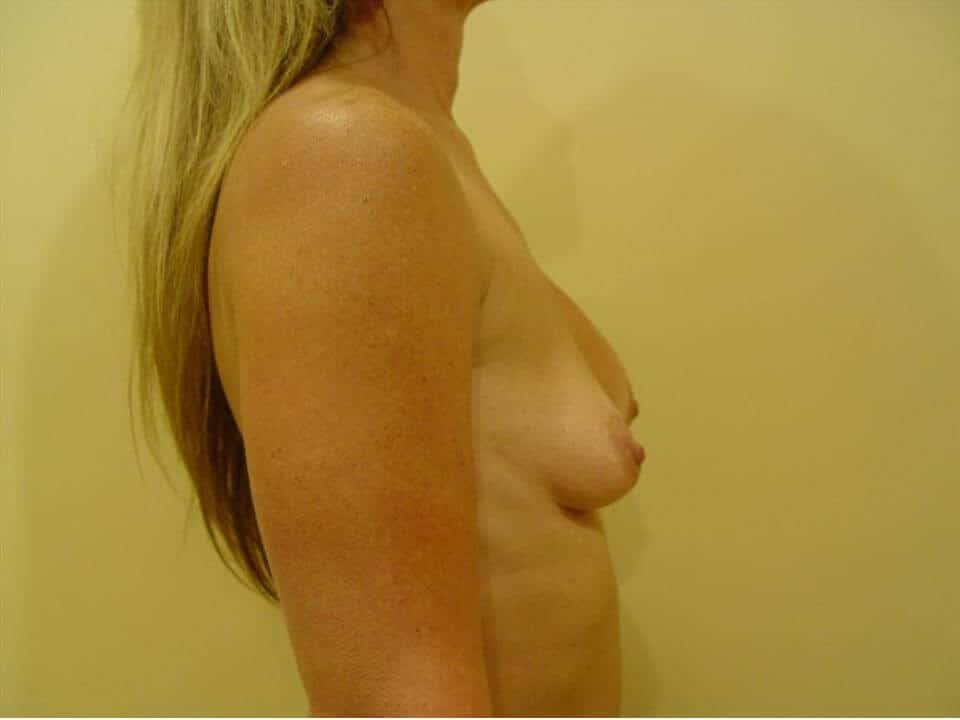 Before & After Patient