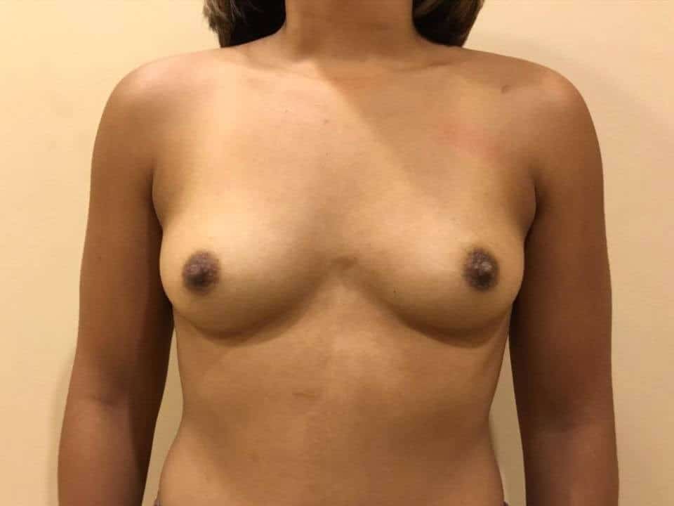 Before & After Patient