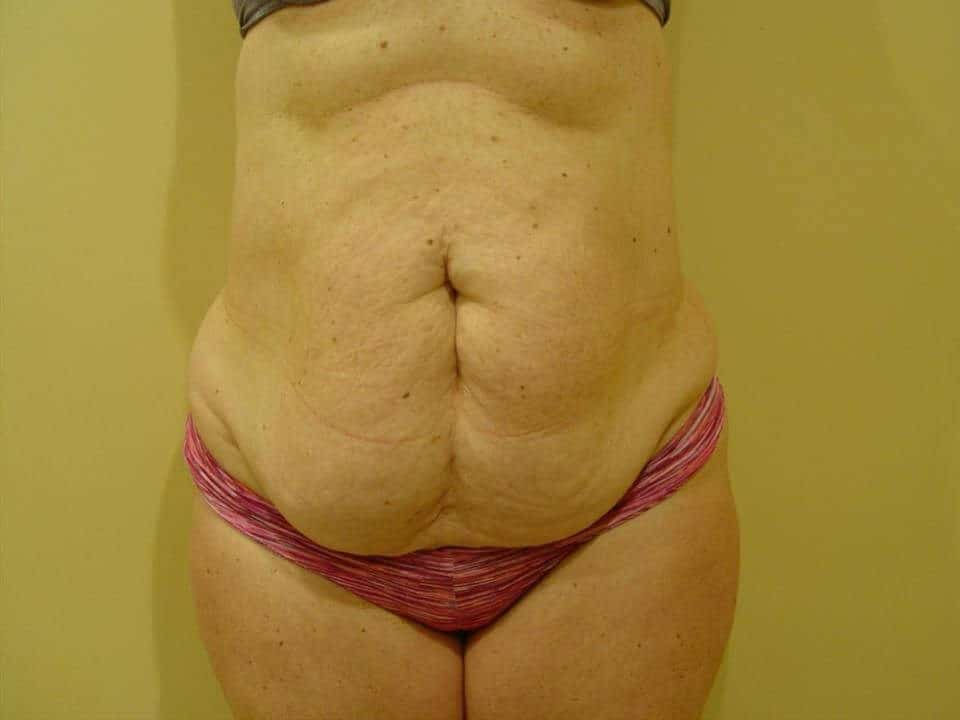 Before & After Patient