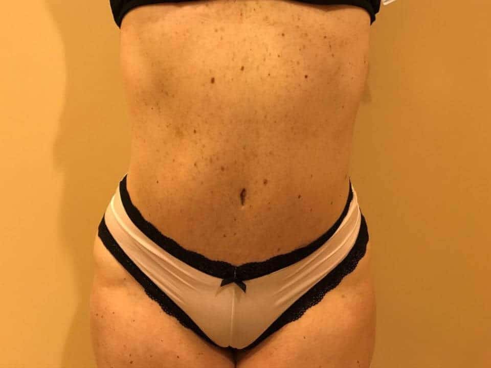 Before & After Patient