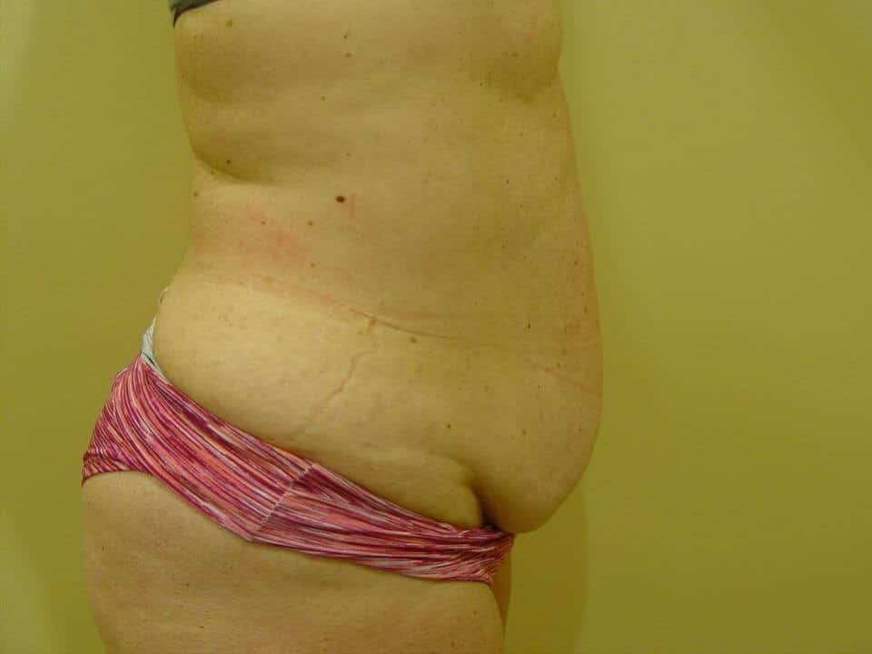 Before & After Patient