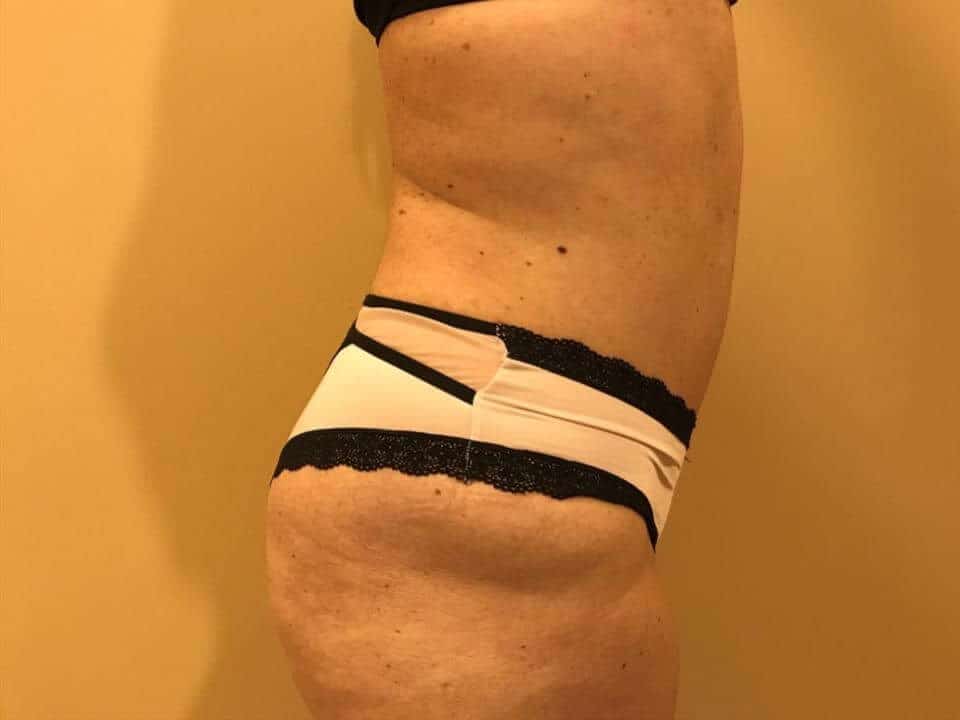 Before & After Patient