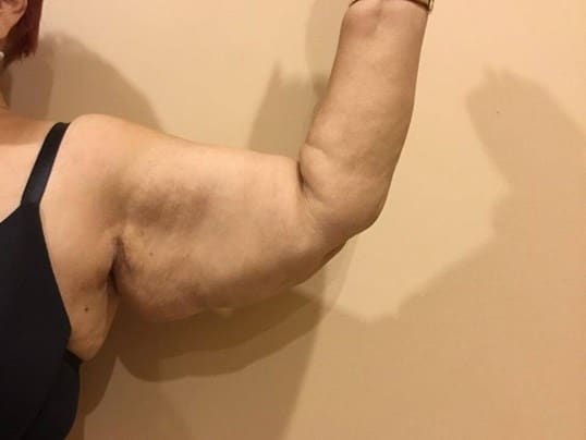 Before & After Arm Lift Patient