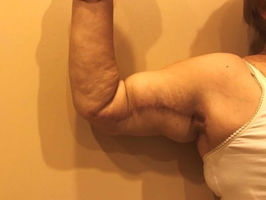 Before & After Arm Lift Patient