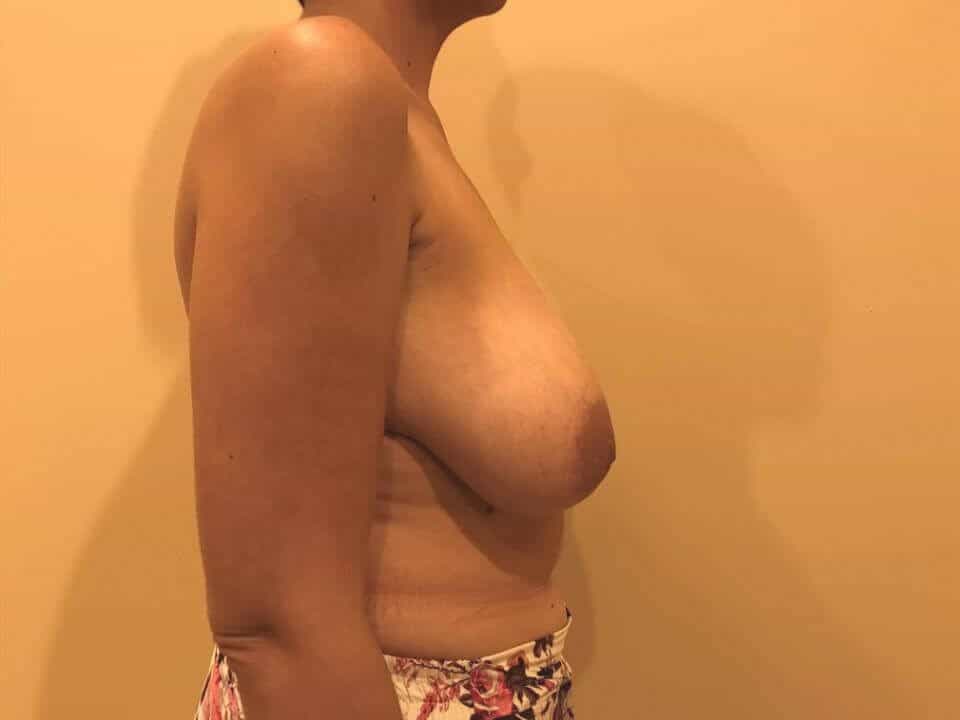 Before & After Patient