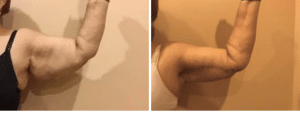 Before & After Arm Lift Patient