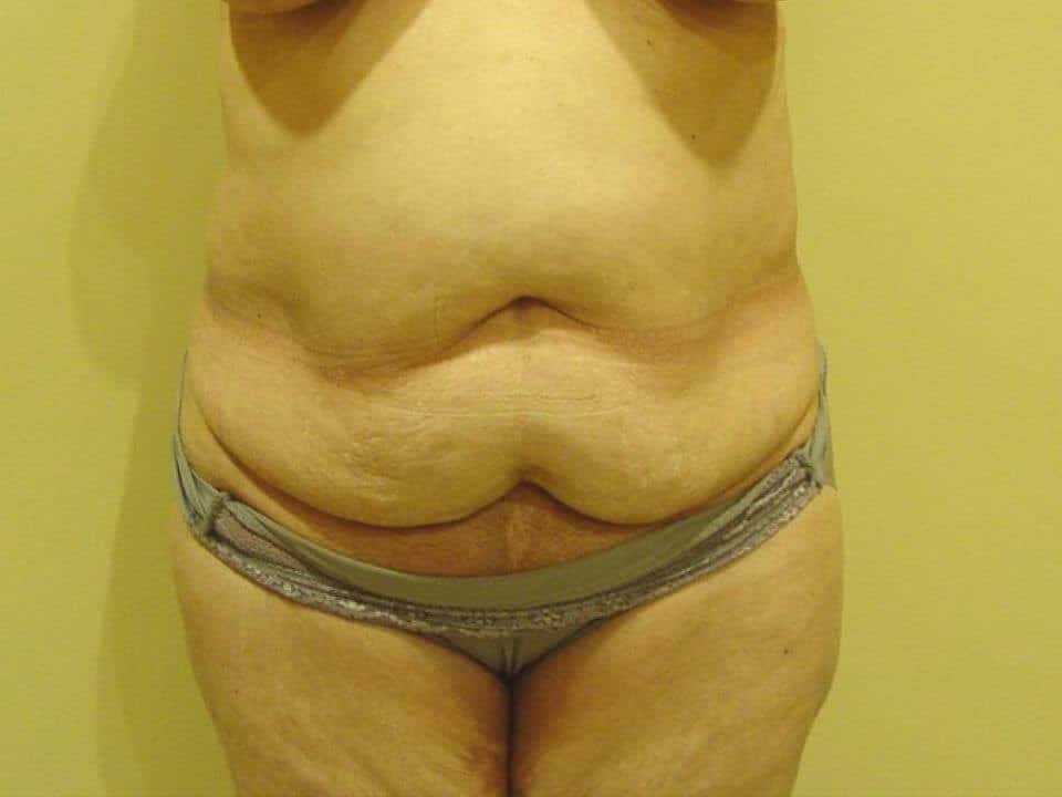 Before & After Patient