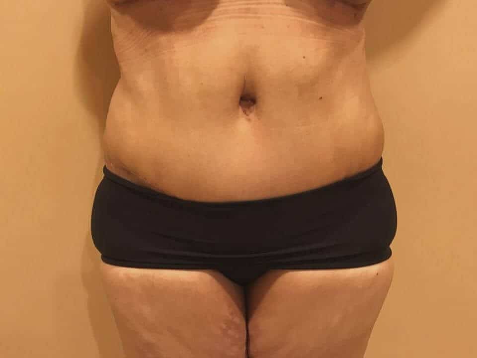 Before & After Patient