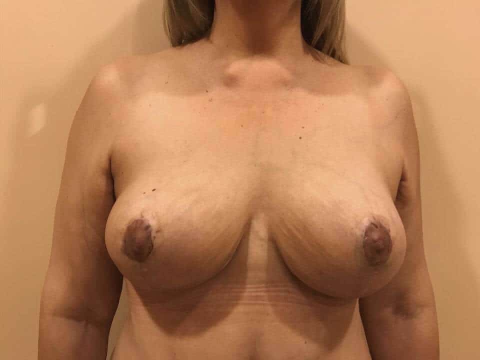 Before & After Patient