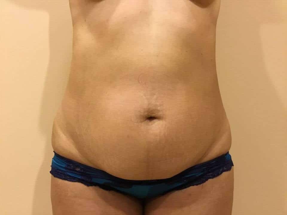 Before & After Patient