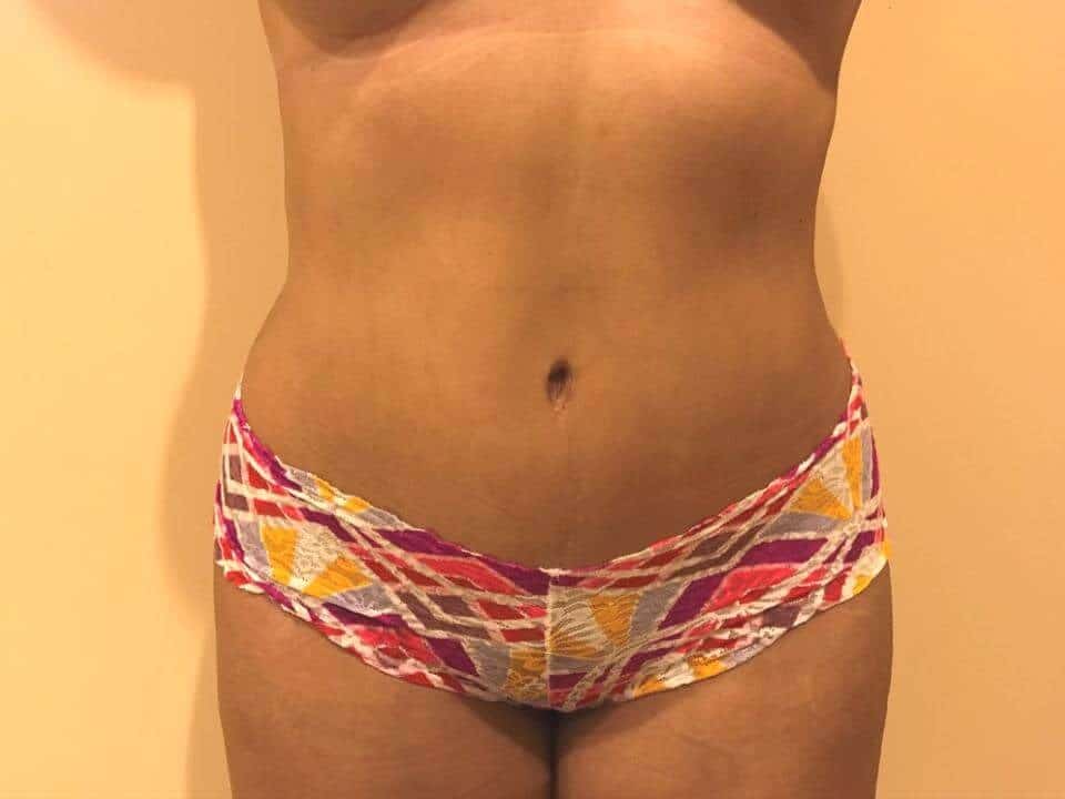 Before & After Patient