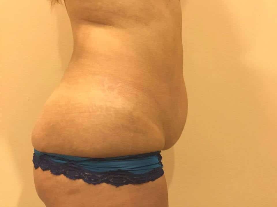 Before & After Patient