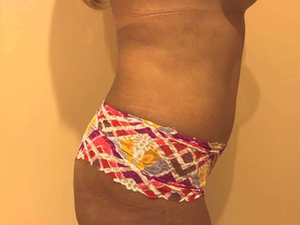 Before & After Patient