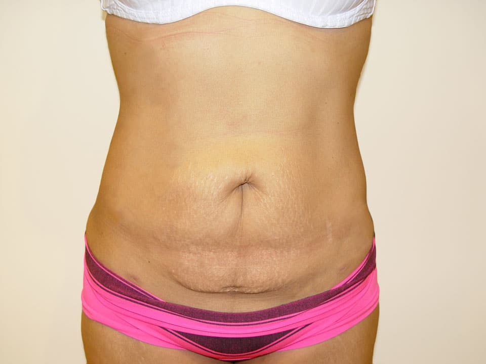 Before & After Patient