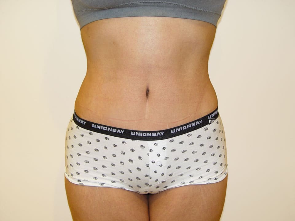 Before & After Patient