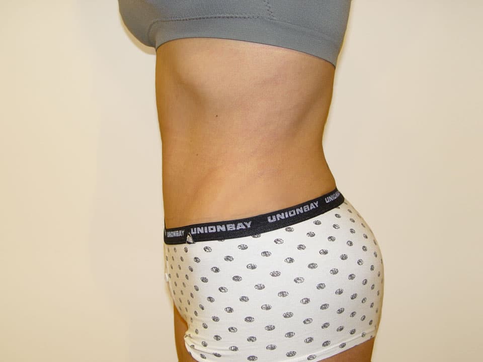 Before & After Patient