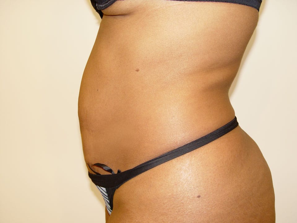 Before & After Patient