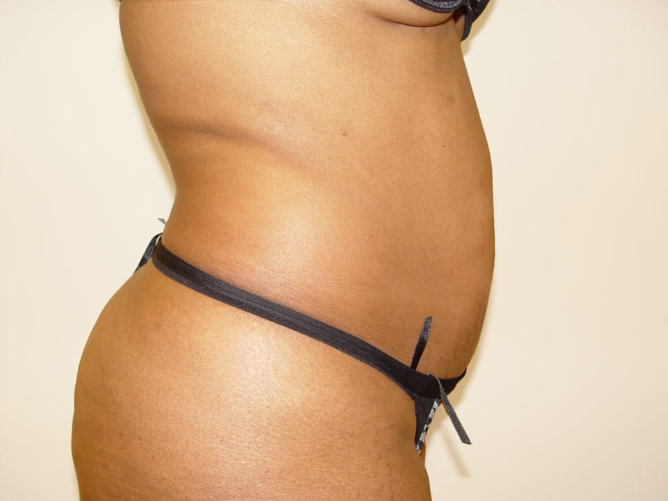 Before & After Patient