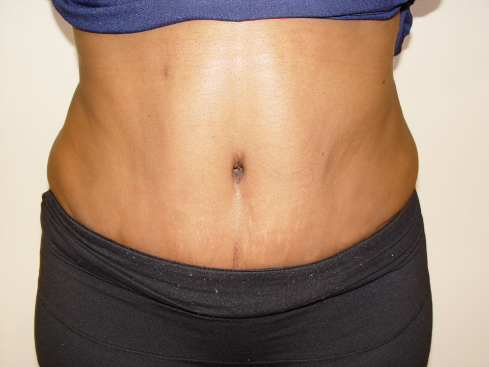 Before & After Patient