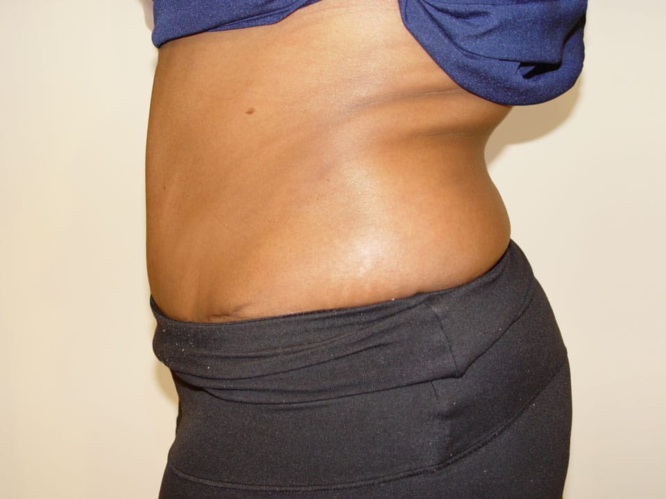 Before & After Patient