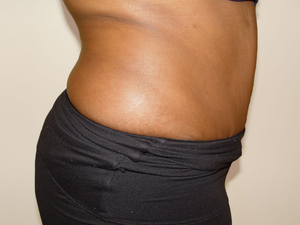 Before & After Patient