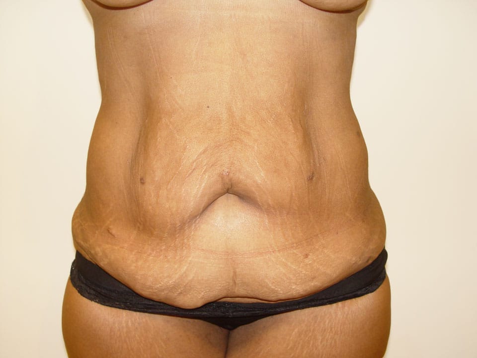 Before & After Patient