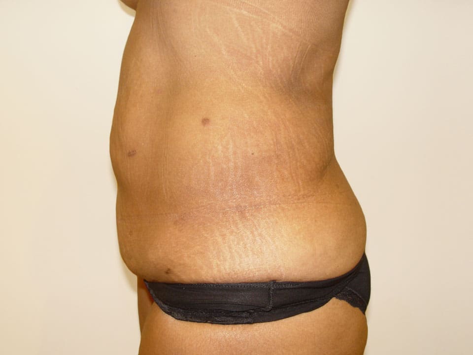 Before & After Patient