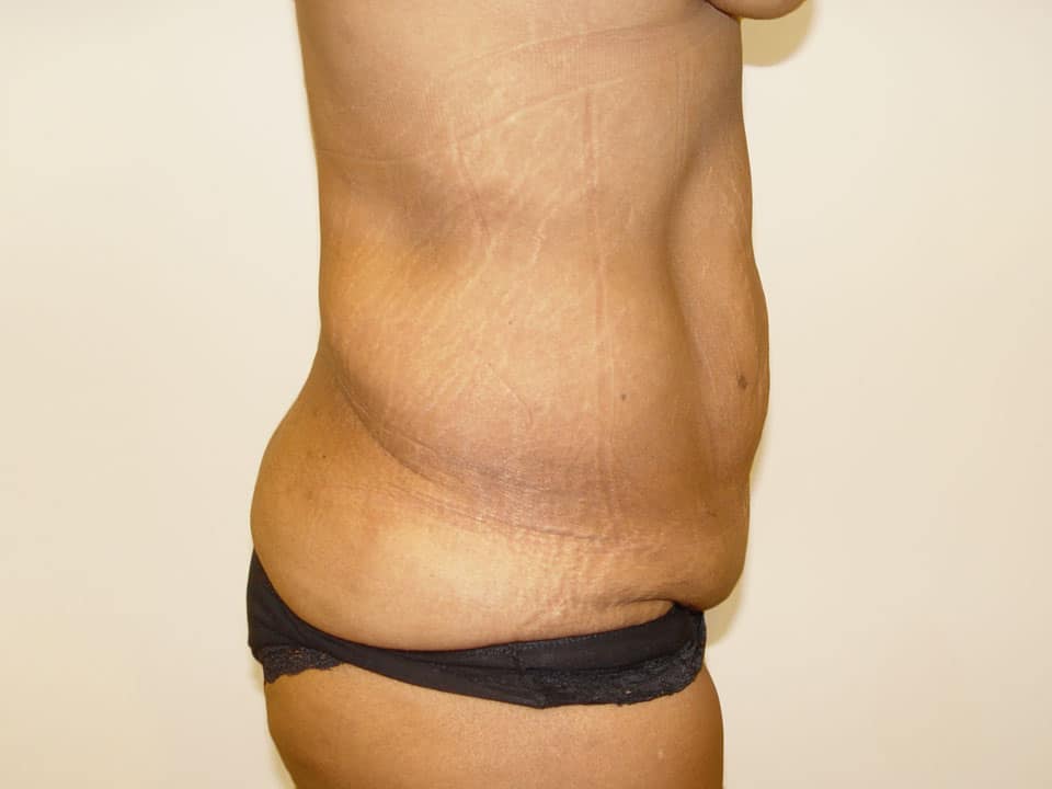 Before & After Patient