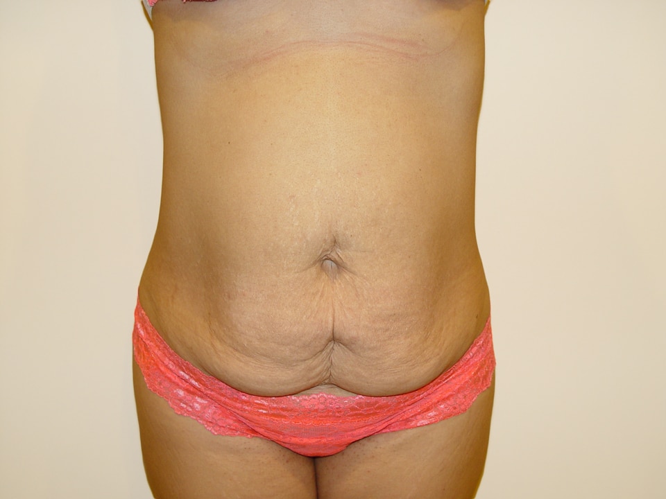 Before & After Patient