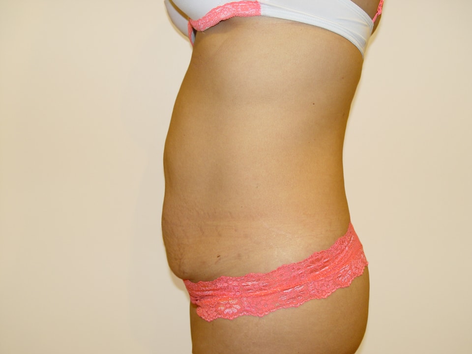 Before & After Patient