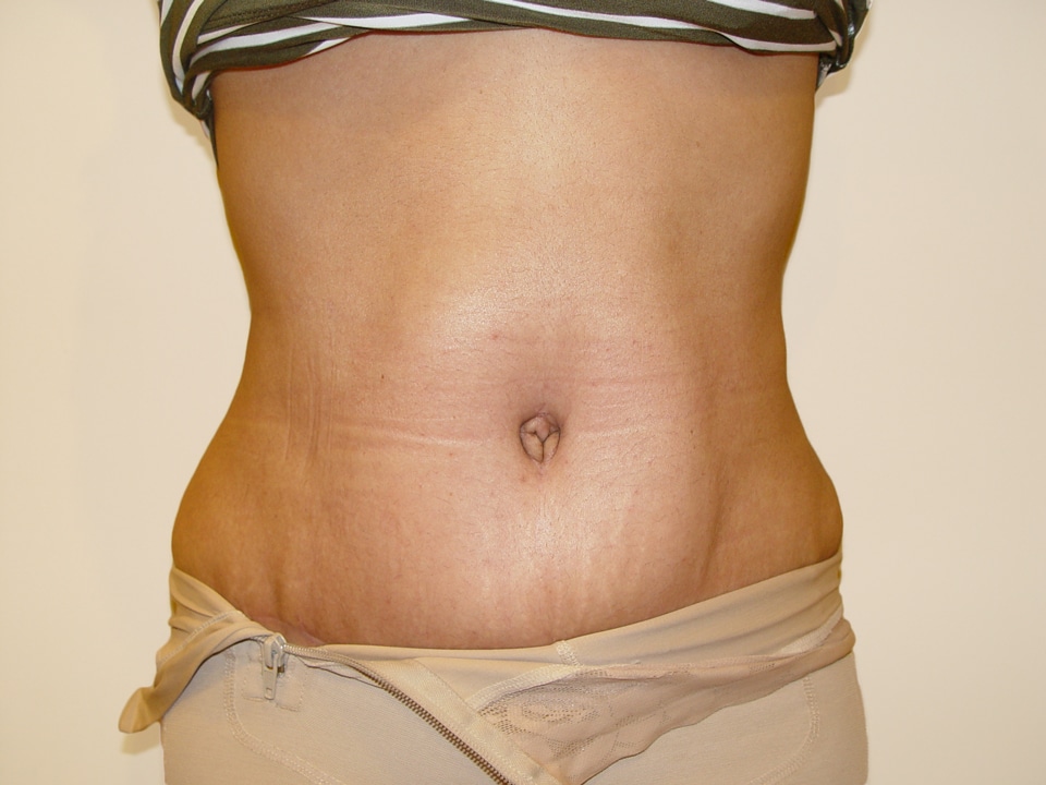 Before & After Patient