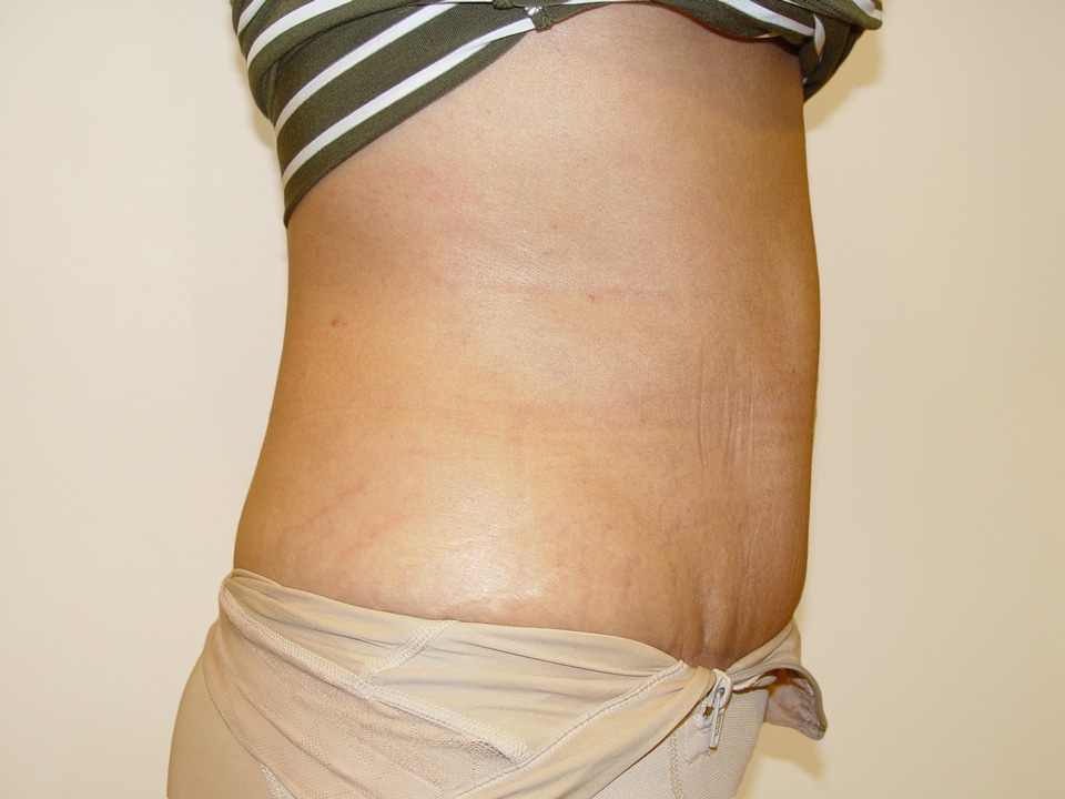 Before & After Patient