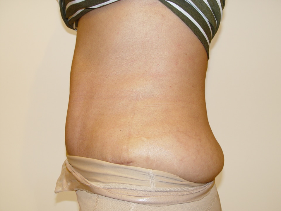 Before & After Patient