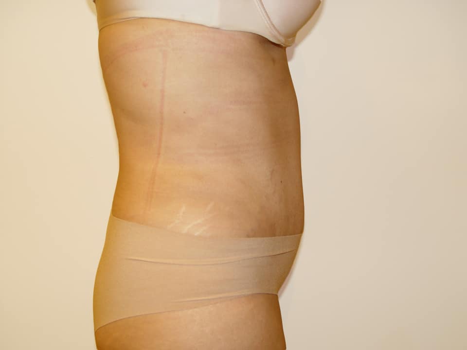 Before & After Patient