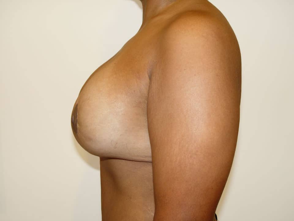 Before & After Patient