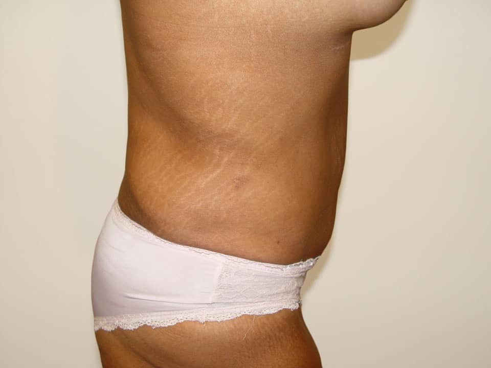 Before & After Patient