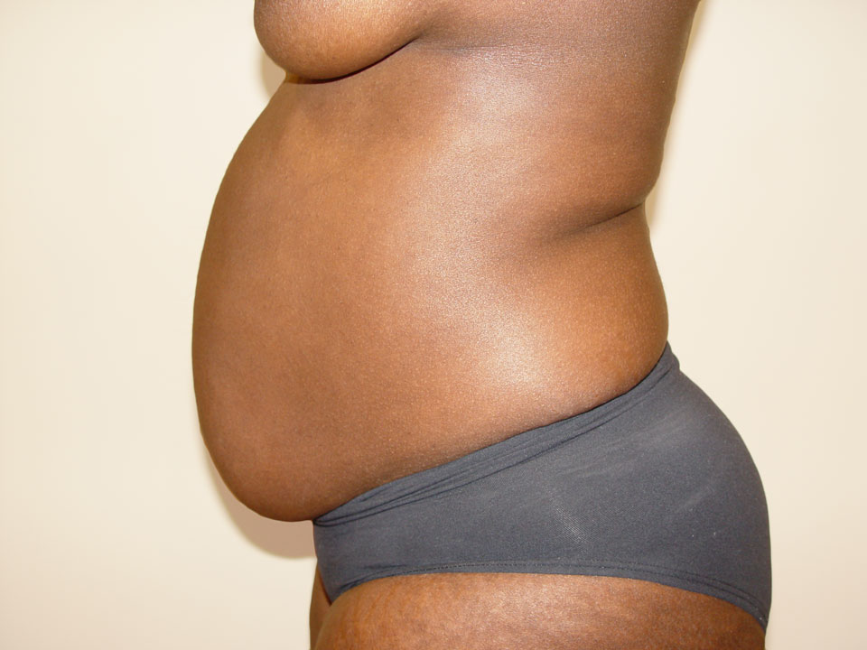 Before & After Patient