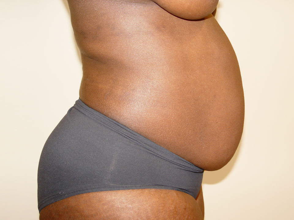 Before & After Patient