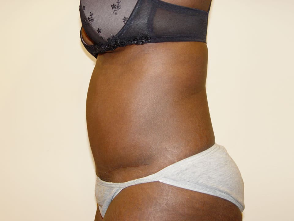 Before & After Patient