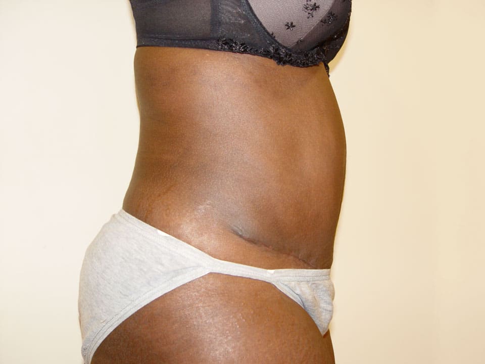 Before & After Patient