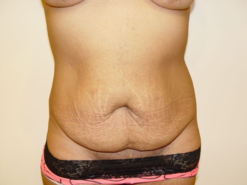 Before & After Patient