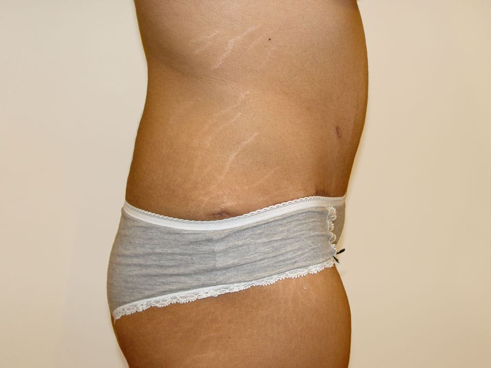 Before & After Patient