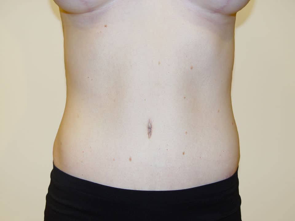 Before & After Patient