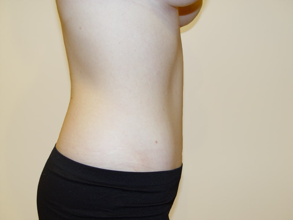 Before & After Patient