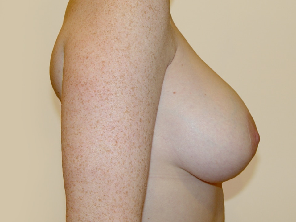 Before & After Patient